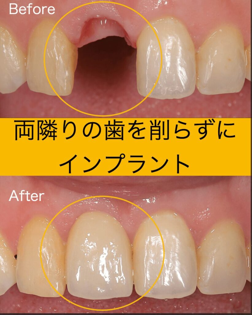 両隣の歯を削らずにインプラント
