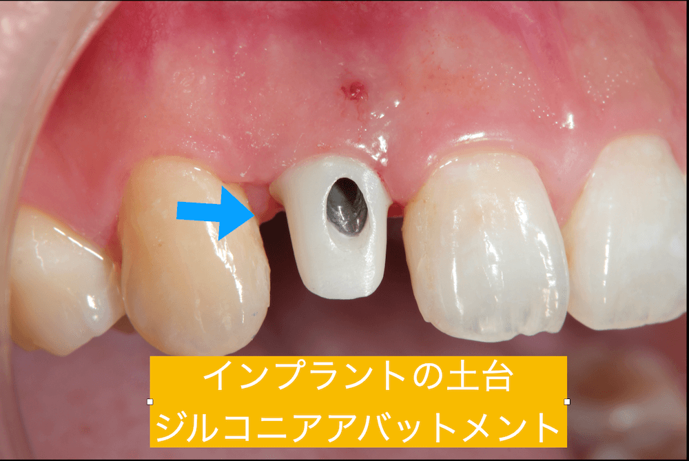 インプラントの土台 ジルコニアアバットメント