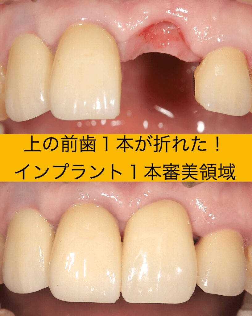 上の前歯1本が折れた方のインプラント1本治療、審美領域