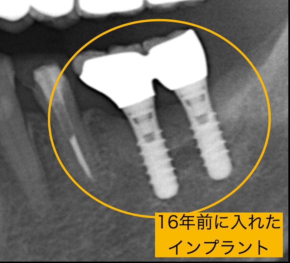 16年前に埋入したインプラント