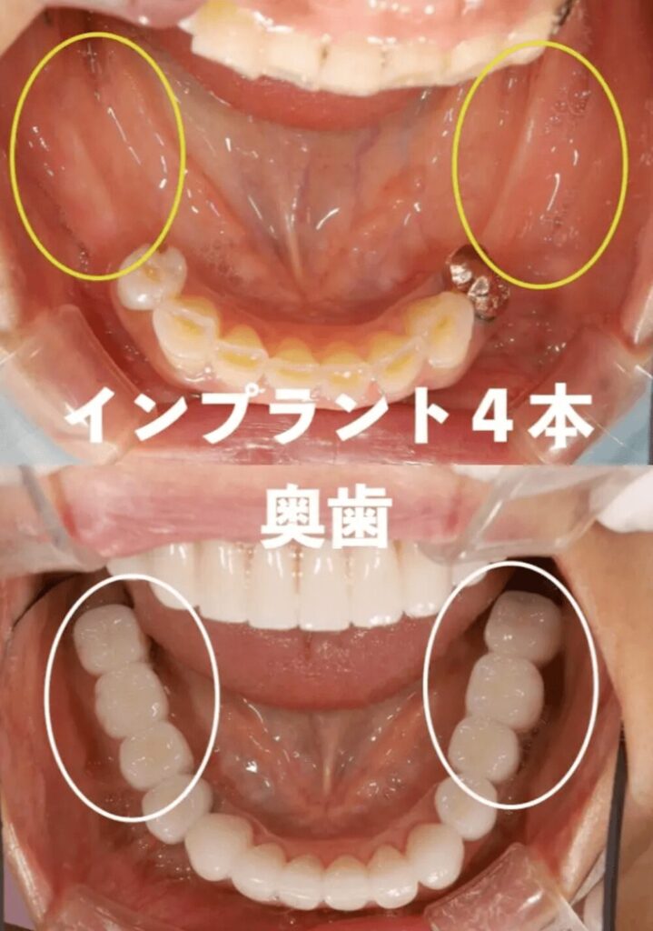 ６０代女性インプラント体験談
奥歯が入れ歯でずっと噛めなくて困っていた患者様
