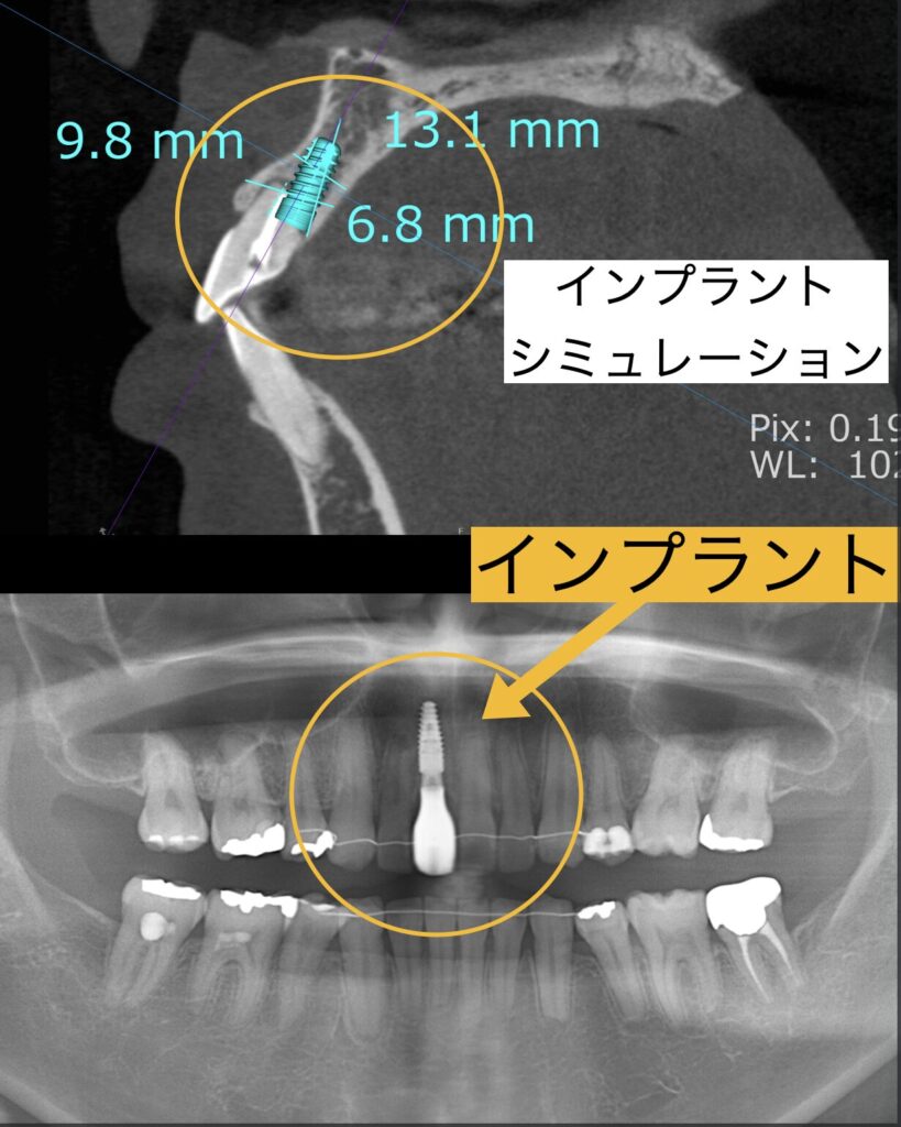 インプラントシミュレーション