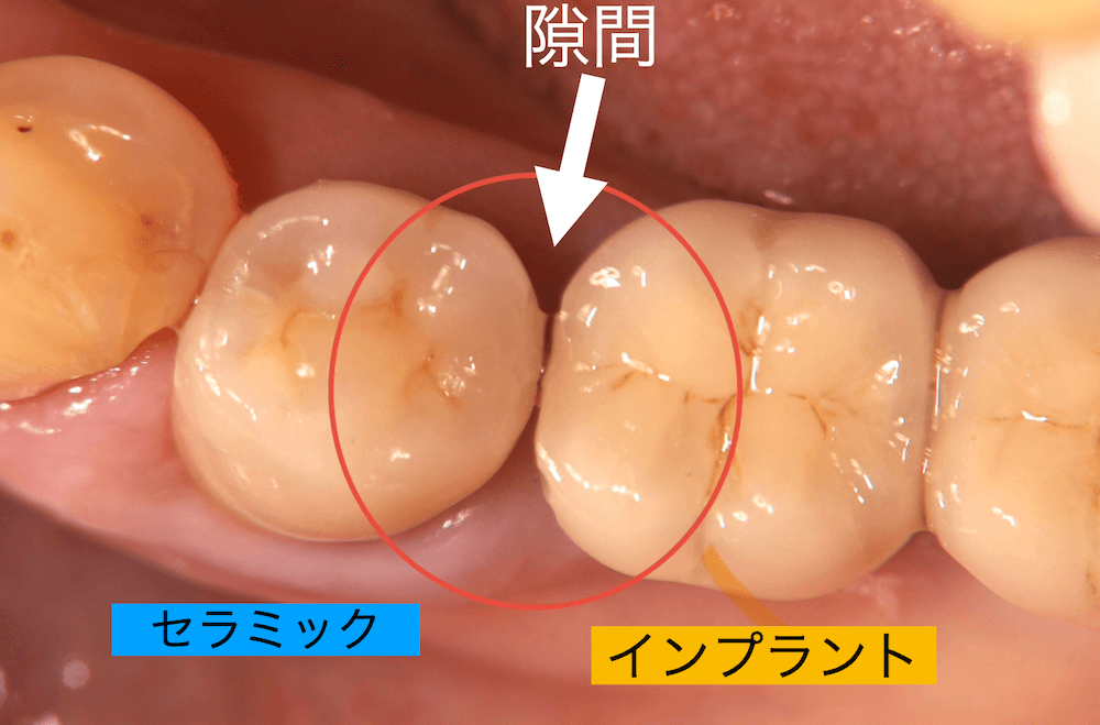 インプラントして16年経過し隣の歯と隙間ができてきたケース
