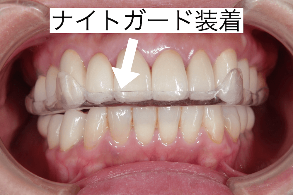 ナイトガードを装着した口腔内の写真