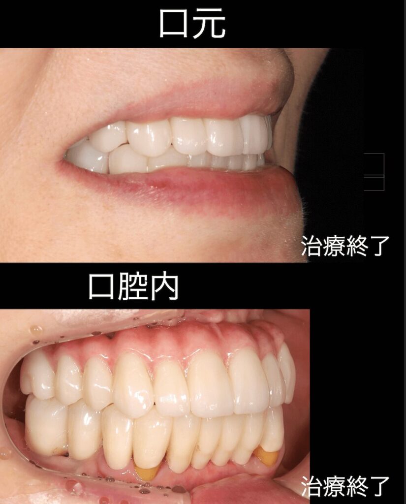 治療終了後のお口元の様子