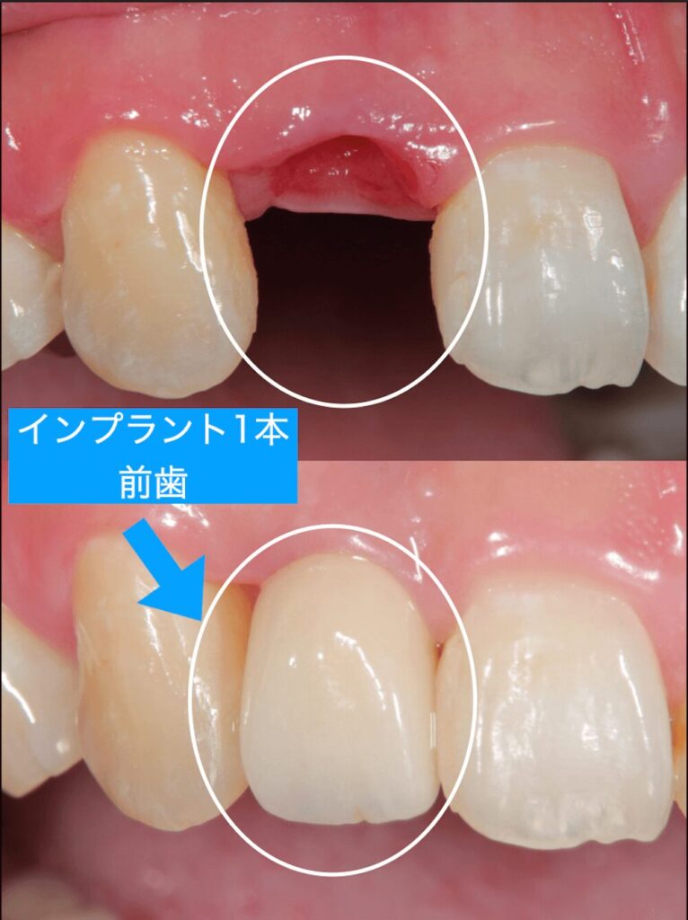 前歯一本インプラント