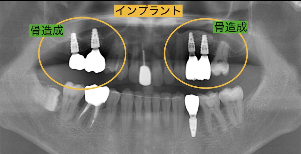 骨が不足している箇所を骨造成で補いインプラントを埋入