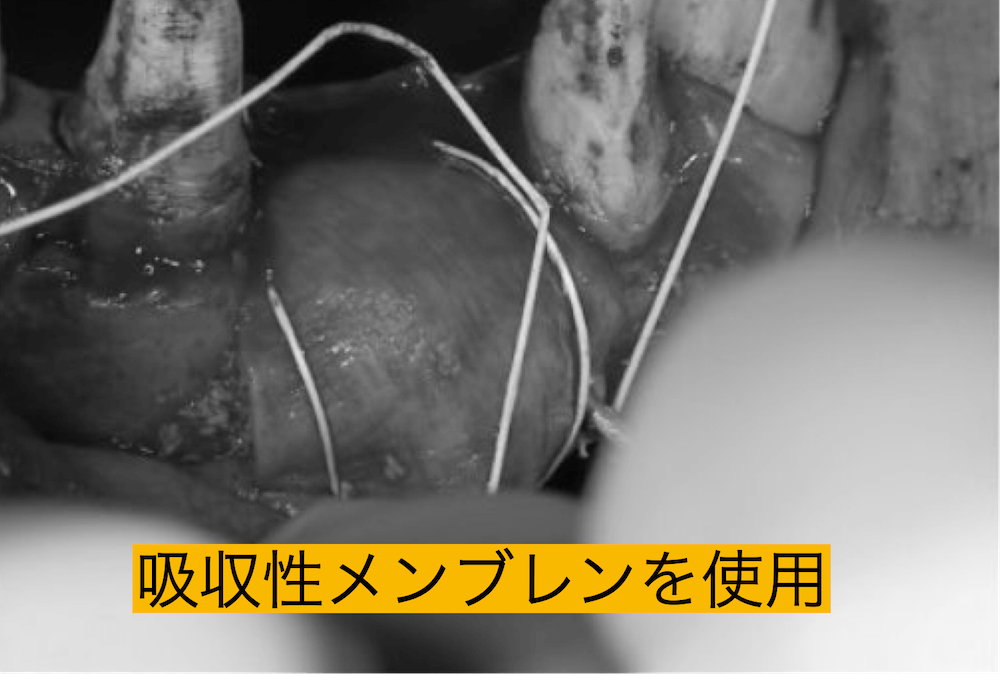 吸収性メンブレンを使用した骨造成(GBR)