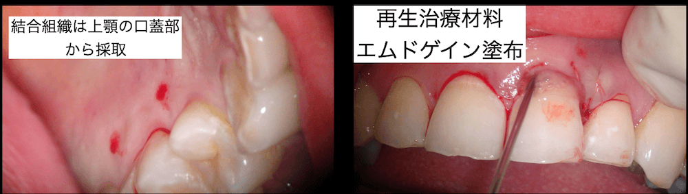 結合組織は上顎の口蓋部から採取。再生治療材料のエムドゲインを塗布