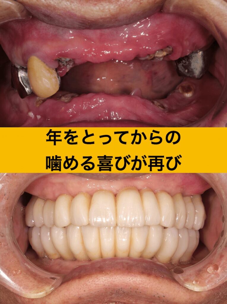78歳でインプラントを決意された患者様の物語