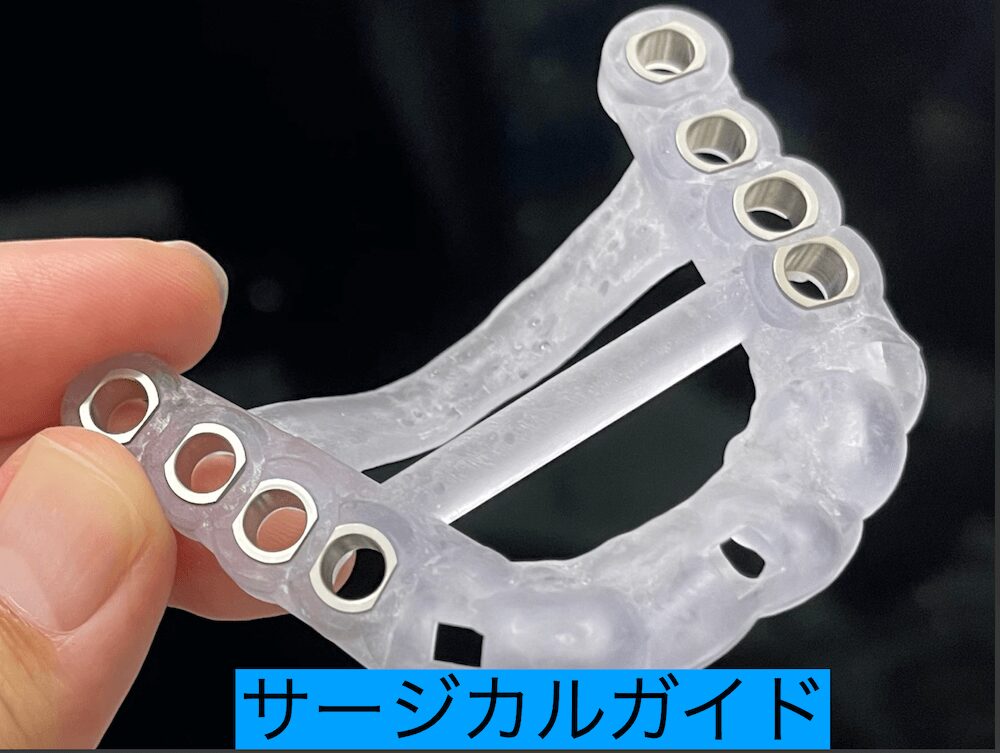 実際のサージカルガイド