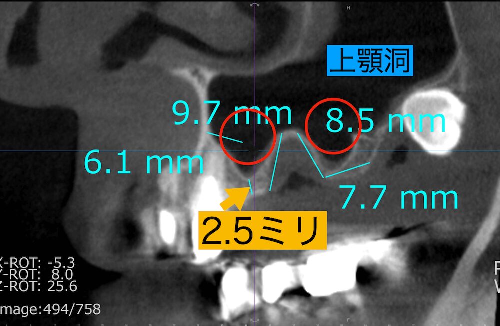 2ウィンドウで上顎洞に骨補填剤を挿入する計画