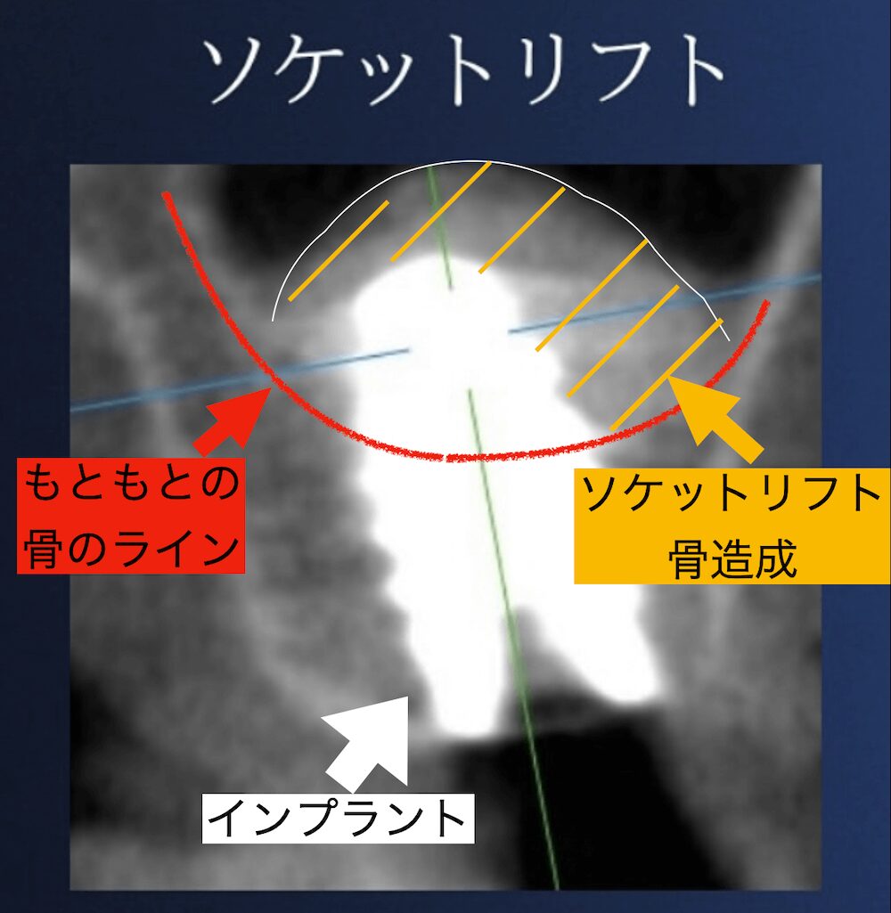 元々の骨のラインを押し上げるソケットリフトによる骨造成