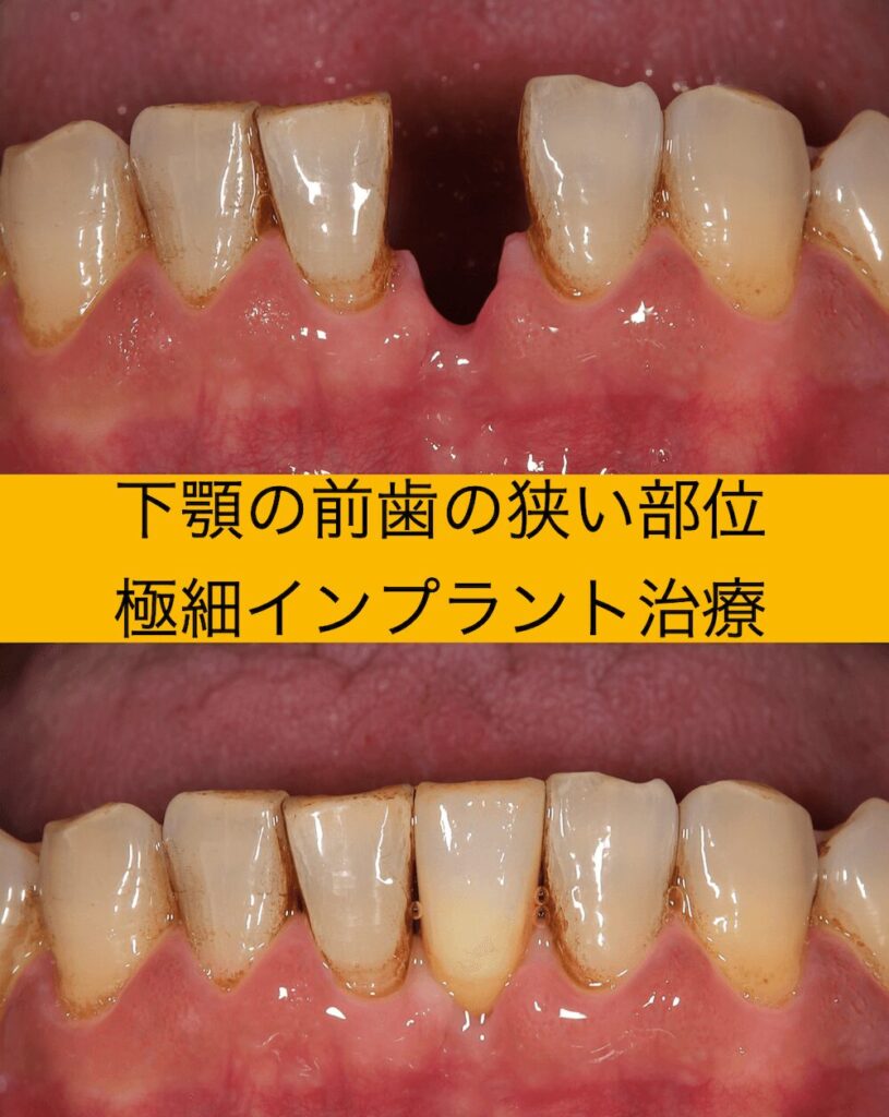 下顎の前歯の狭い部位 極細インプラント治療