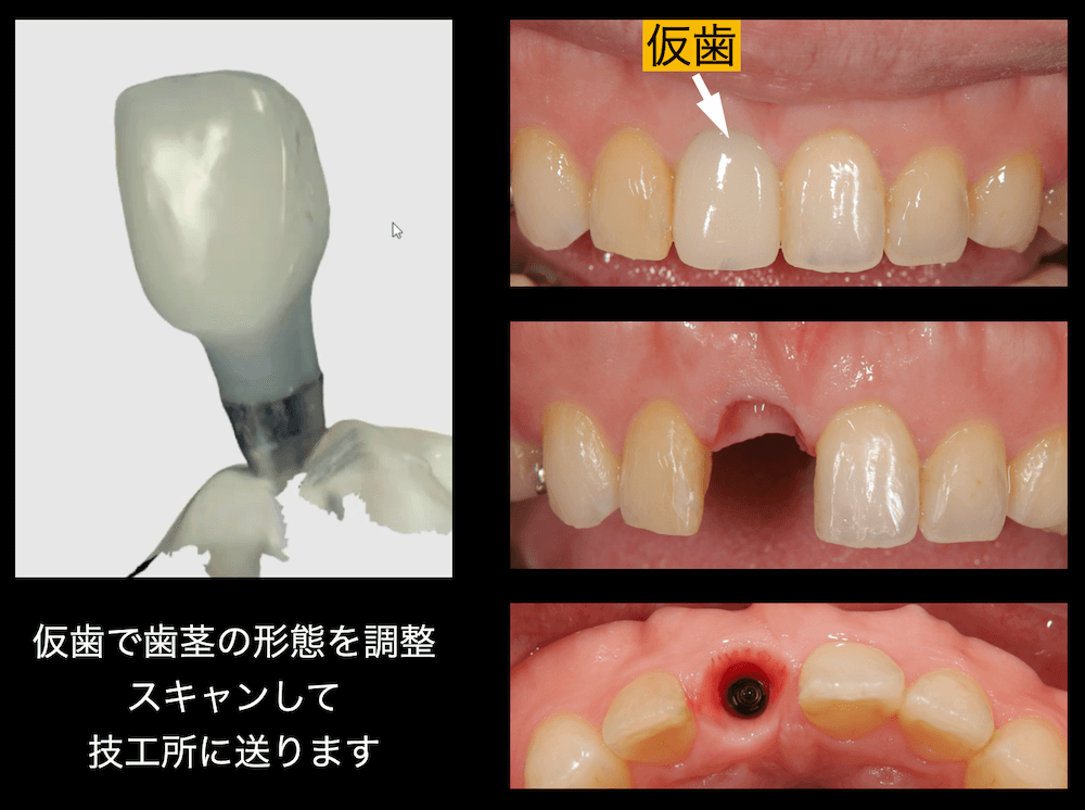 仮歯で歯茎の形態を調整スキャンして技工書に送ります。