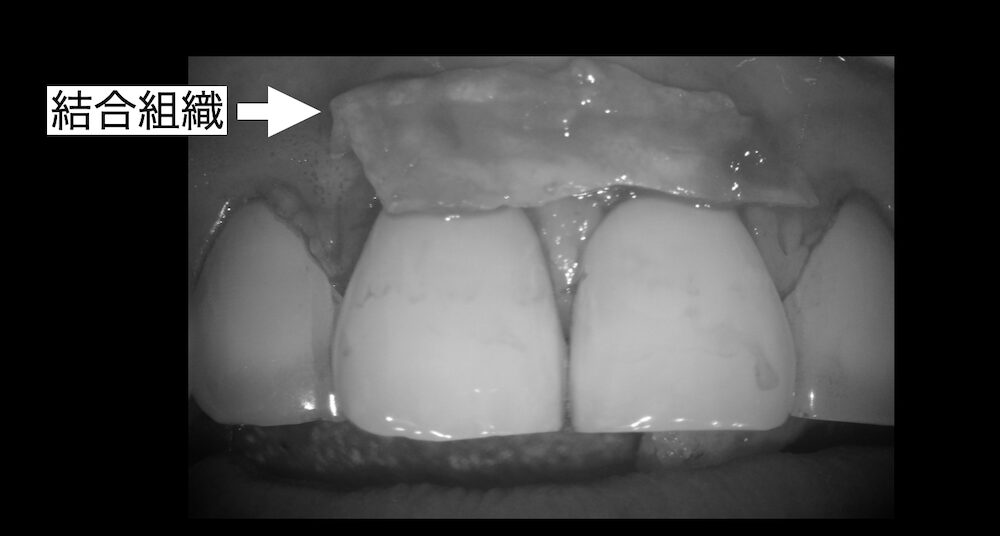 結合組織移植術はやるべきなのか?