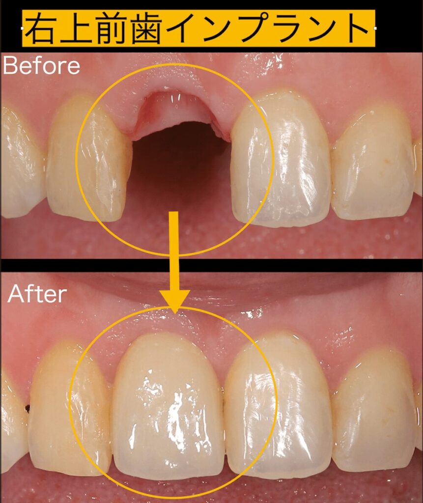 右上前歯インプラント