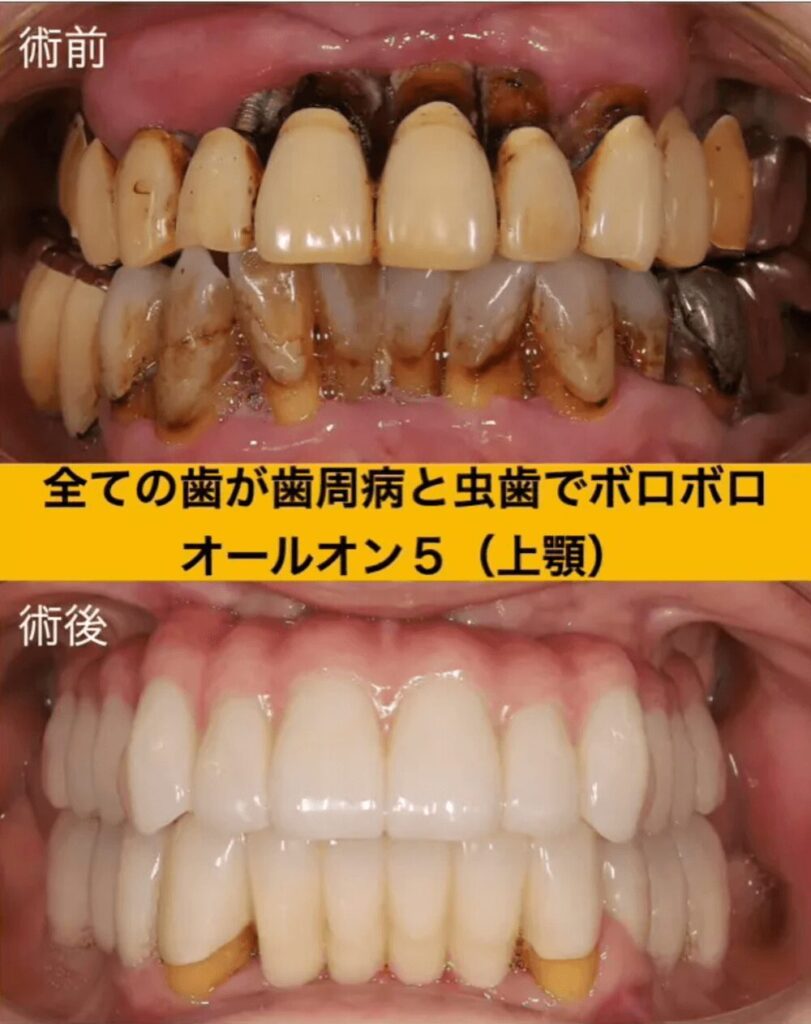 50代女性｜全ての歯がボロボロのお口から変身したケース