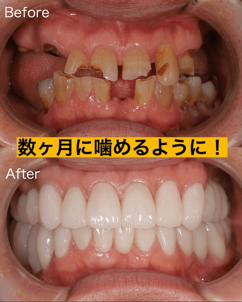 数ヶ月で治療を終えて噛めるように