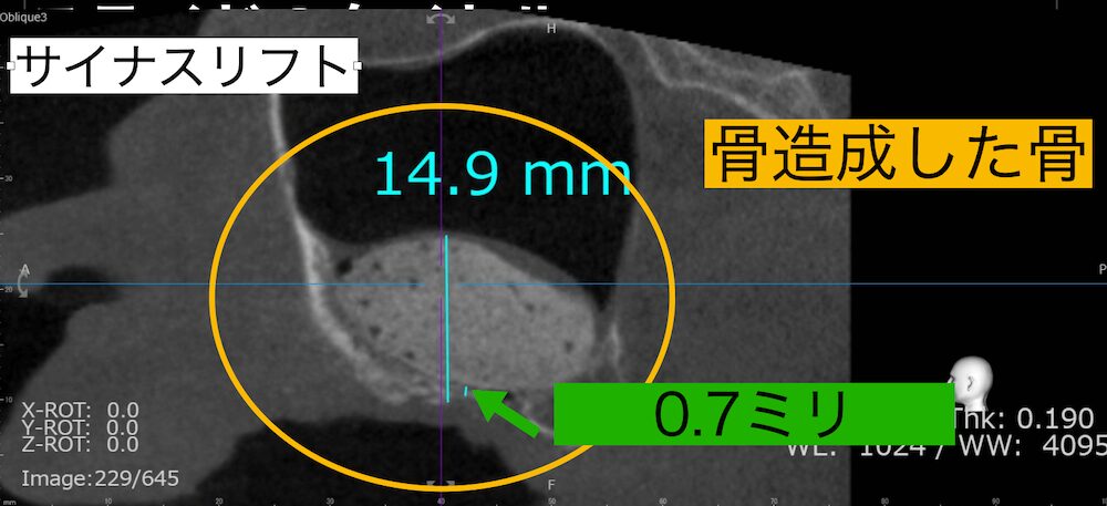 CTシミュレーションを活用してサイナスリフトを行った症例