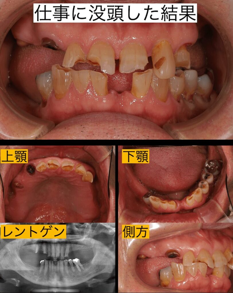 仕事に没頭した結果、歯科治療がおろそかになり歯がボロボロに