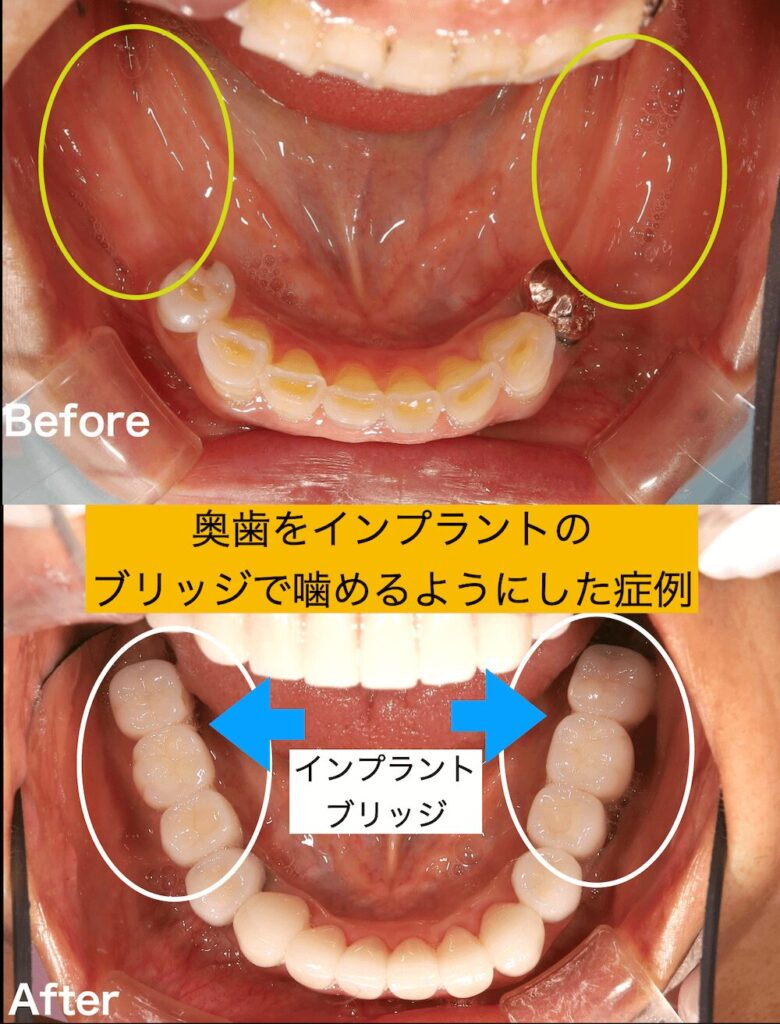 奥歯をインプラントのブリッジで噛めるようにした症例