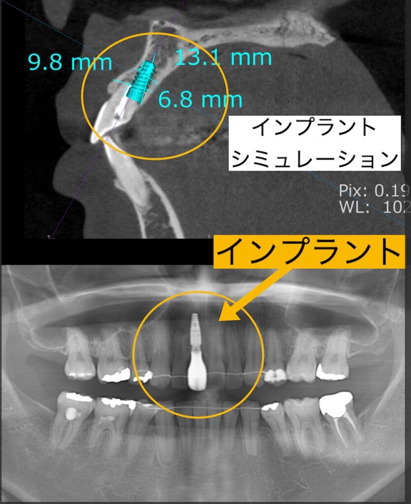 インプラントシミュレーション