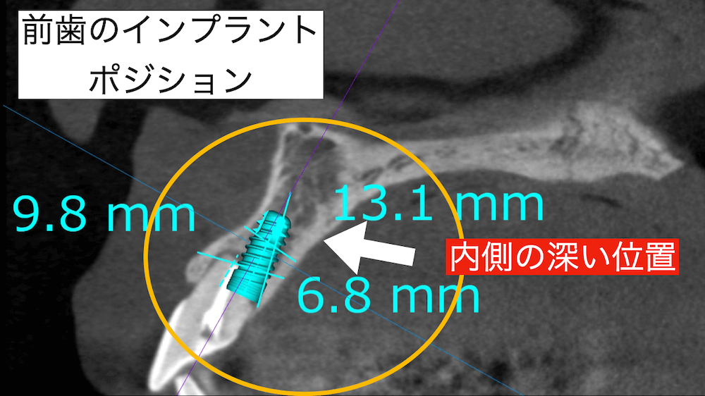 前歯のインプラントポジションは内側の深い位置