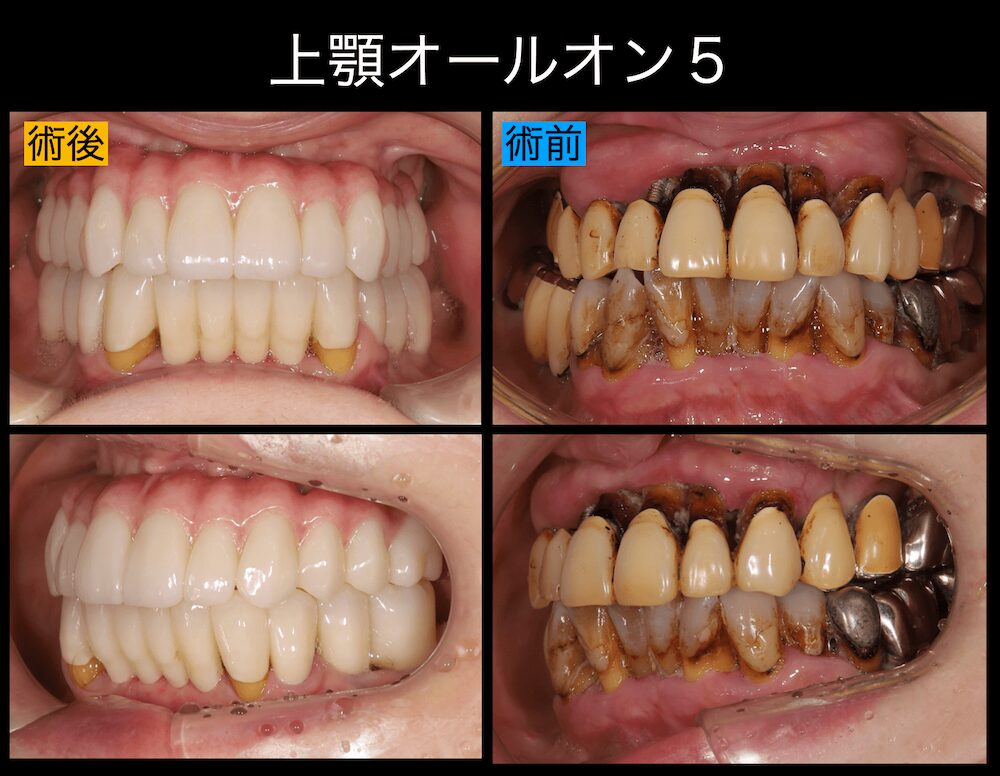 上顎オールオン5