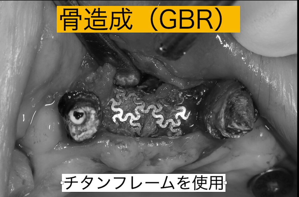 チタンフレームを使用した骨造成(GBR)