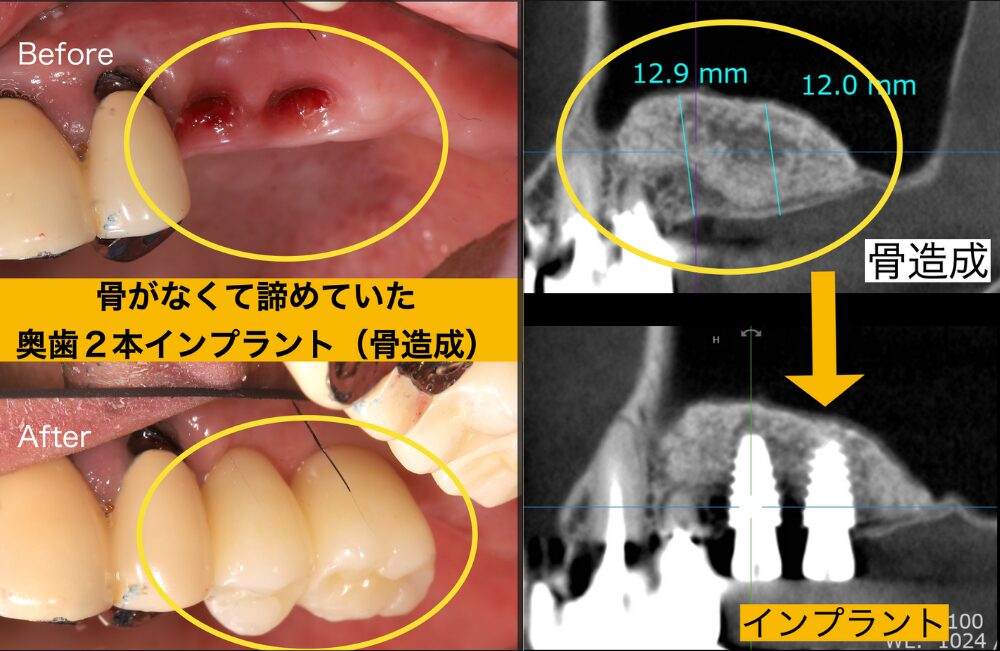 骨がないと他院で言われて諦めていた患者様の体験談