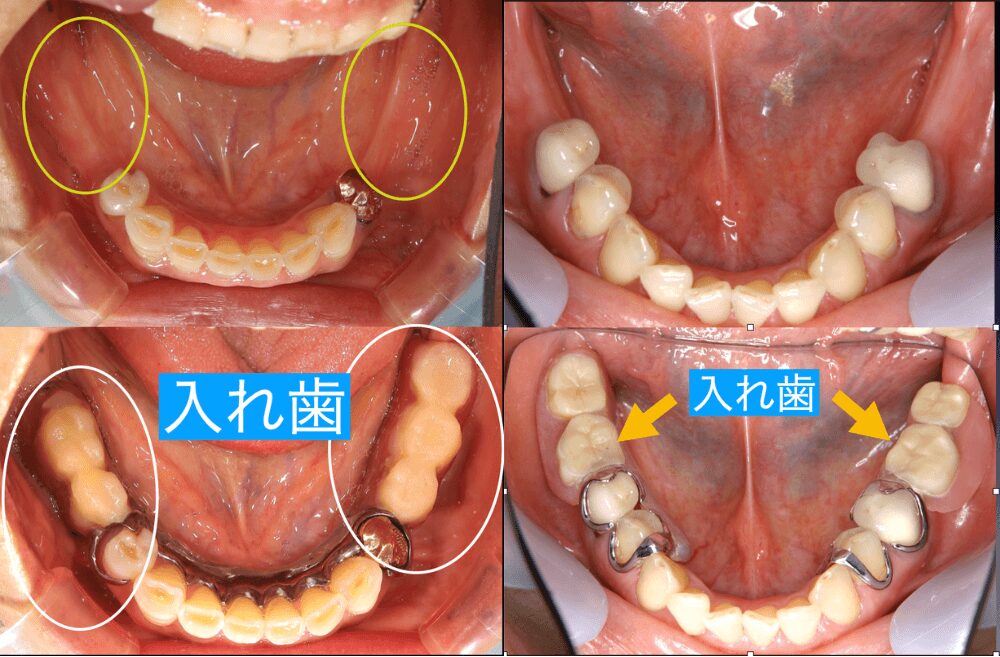 特に「入れ歯では噛みにくい」「見た目が気になる」と感じている方や、仕事や生活の中で自然な会話や食事を大切にしたい方にとって、この治療法は選択肢となり得ます。