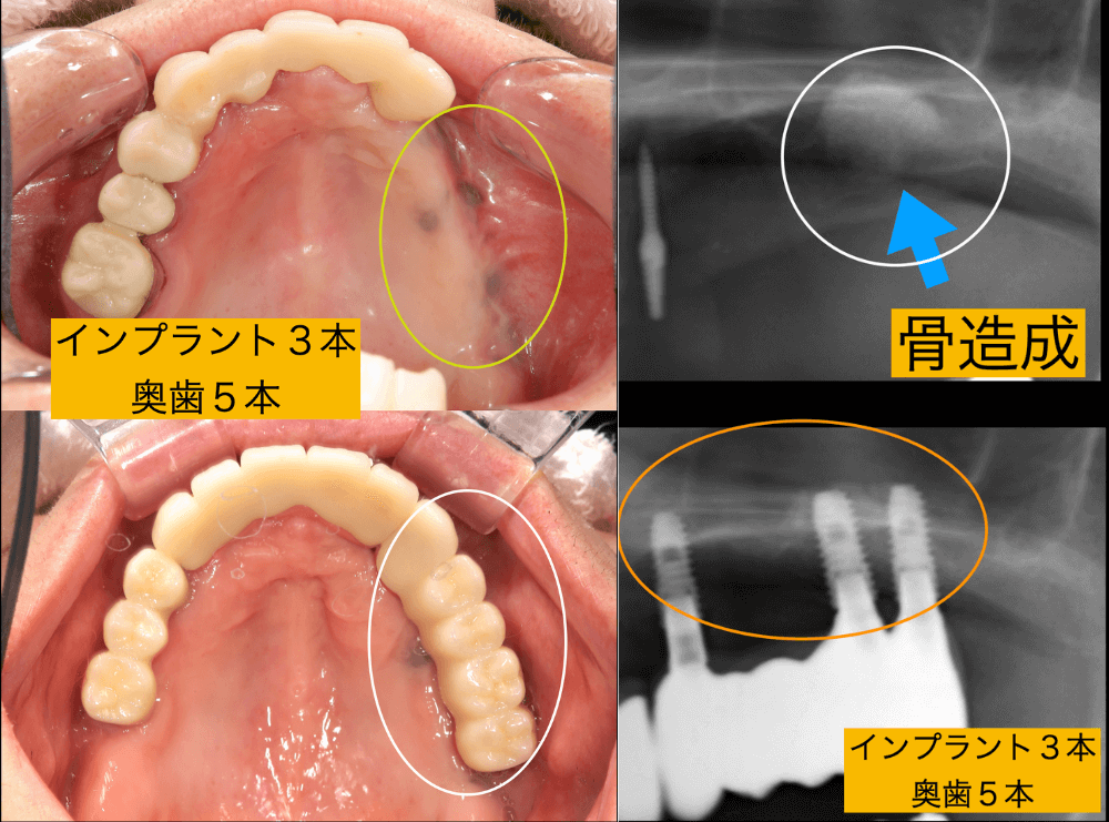 インプラント3本で奥歯5本を補った症例