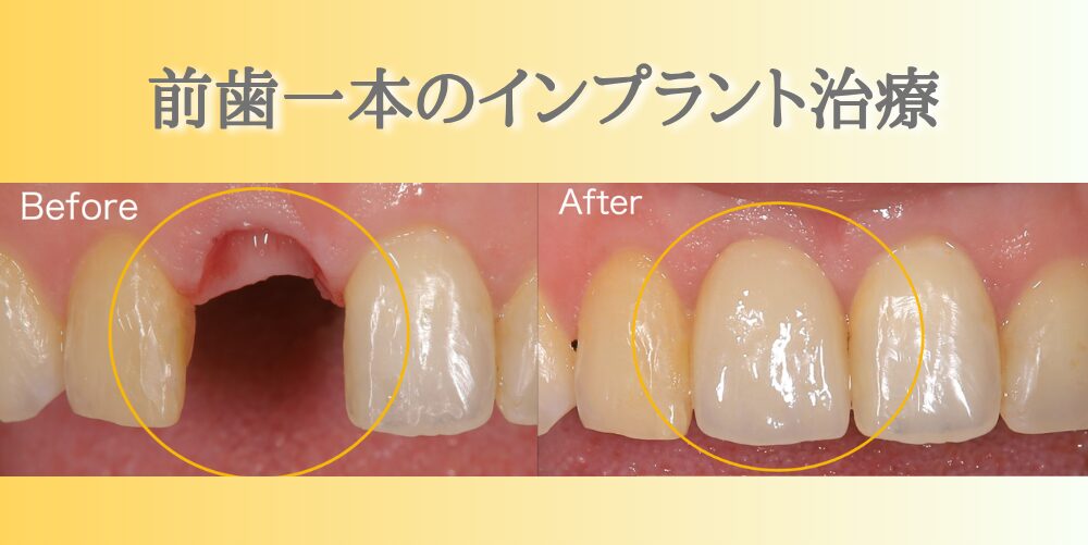 前歯1本のインプラント治療