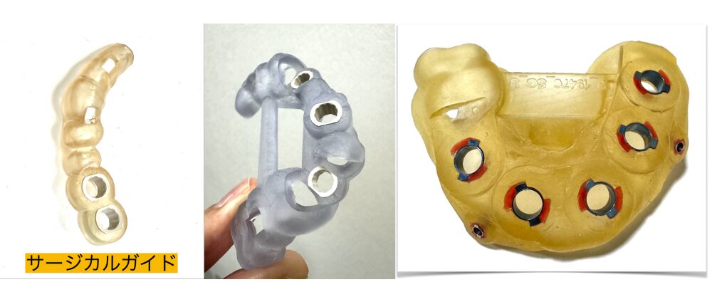 当院で使用している様々なサージカルガイド