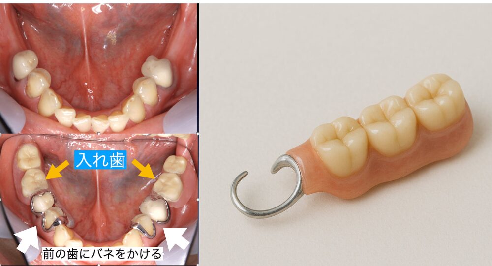 入れ歯は近くの歯にバネをかける。