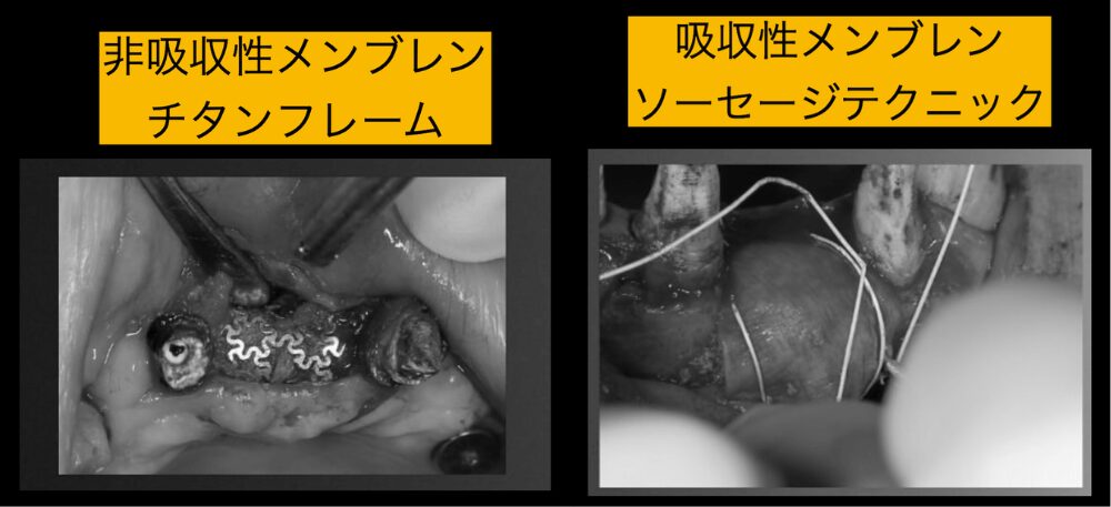非吸収性メンブレン チタンフレーム
吸収性メンブレン ソーセージテクニック