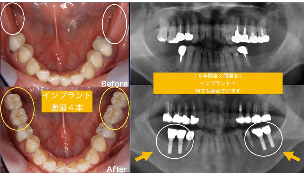 インプラント16年間経過症例でも全く問題なく経過良好