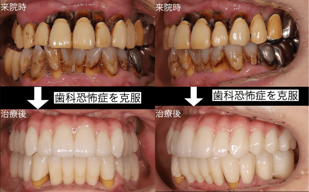 歯科恐怖症を克服ししっかり噛めるお口へ