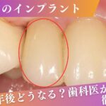 前歯インプラントの10年後｜見た目・機能・長期安定性を専門医が解説