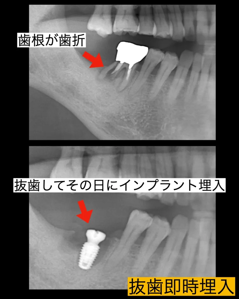 歯根が真っ二つに破折