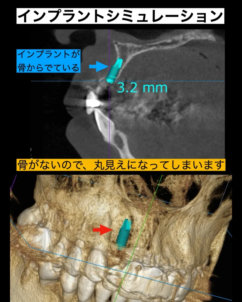 インプラントシミュレーション
