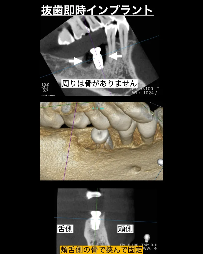 抜歯即時インプラント