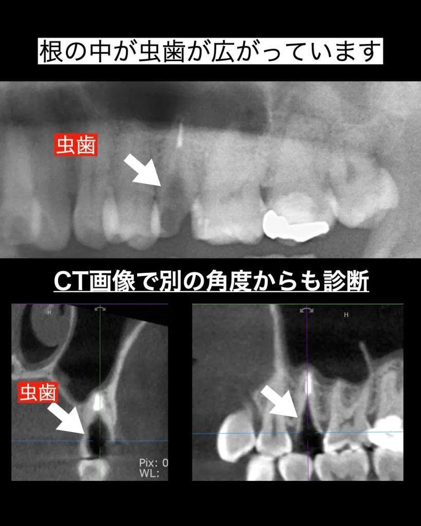 歯の根の中まで虫歯が広がっており、保存は困難で抜歯が必要と判断