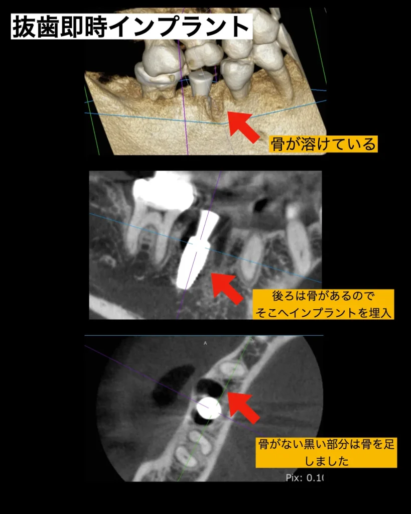インプラント手術