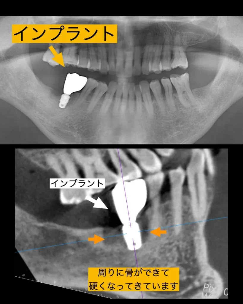 骨と生着し硬くなっている