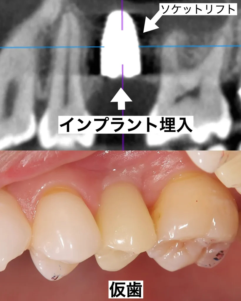 インプラント埋入
