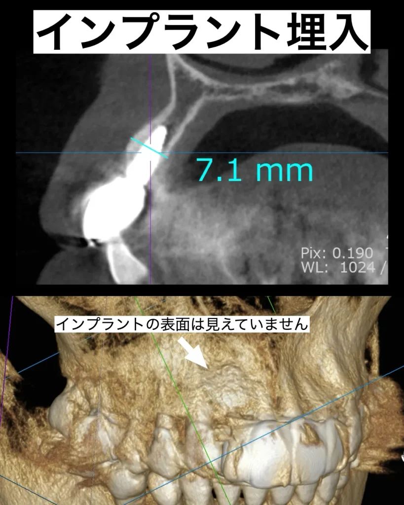 インプラント埋入