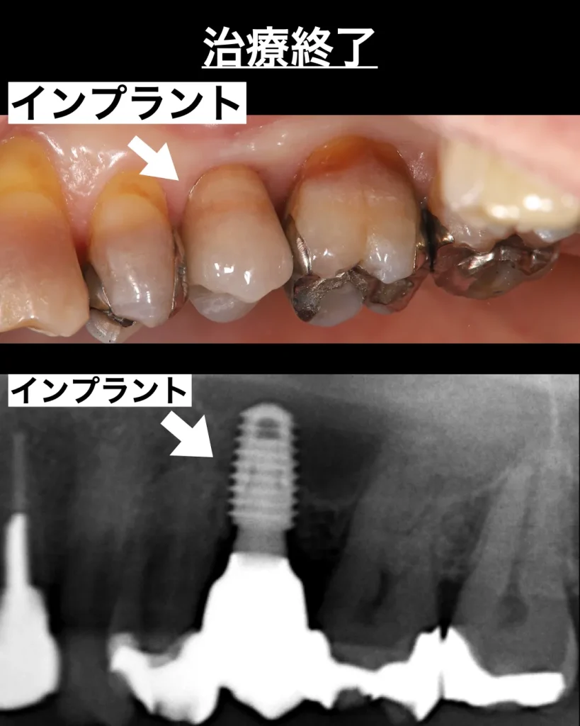 最終的な被せ物を装着