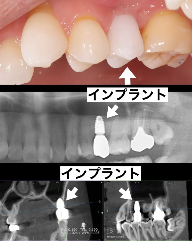 白いセラミックのインプラント